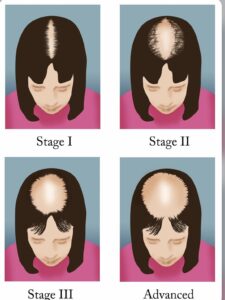 Hair Loss