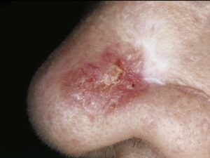 Basal Cell Carcinoma