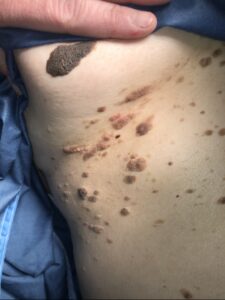 Seborrheic Keratosis