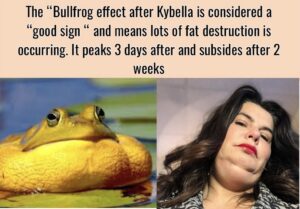 Kybella