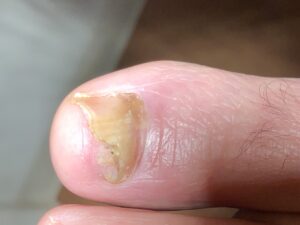 Toenail Fungus