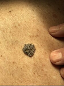 Seborrheic Keratosis