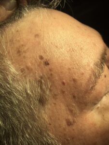 Seborrheic Keratosis