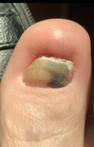 Nail Conditions