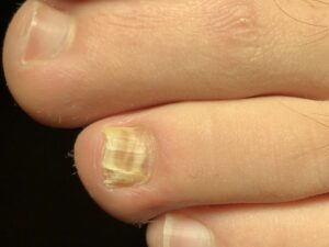 Nail Conditions