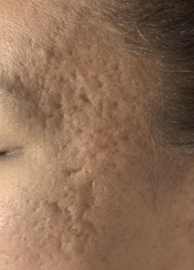 Microneedling | The Art of Skin Dermatology | Poughkeepsie, NY