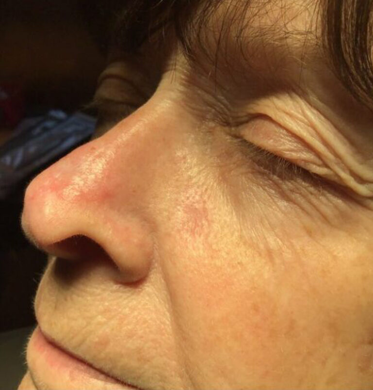 Basal Cell Carcinoma | The Art of Skin Dermatology | Poughkeepsie, NY