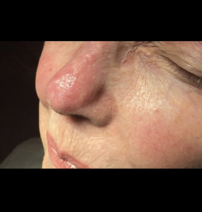 Basal Cell Carcinoma | The Art of Skin Dermatology | Poughkeepsie, NY