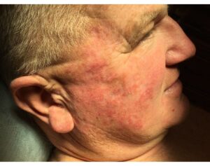 Actinic Keratosis