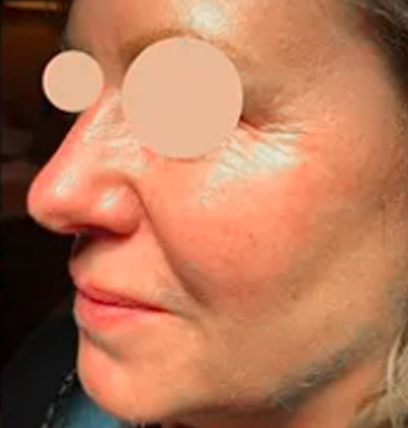 Before & After Gallery | The Art of Skin Dermatology | Poughkeepsie, NY