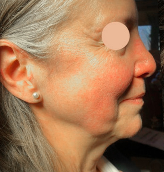 Before & After Gallery | The Art of Skin Dermatology | Poughkeepsie, NY