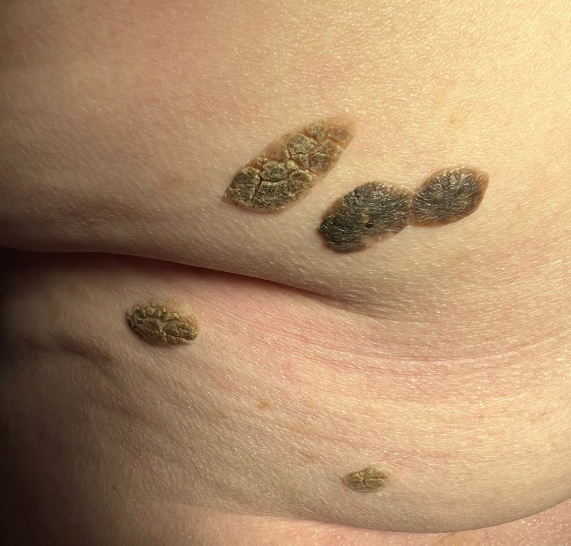 Seborrheic Keratosis