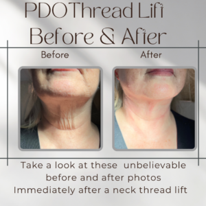 Deep PDO Threadlifts