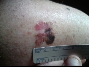 Melanoma Diagnosis and Treatment in NY & CT