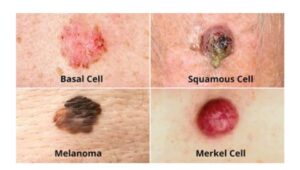 Skin Cancer