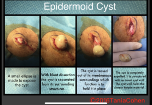 Sebaceous Cysts