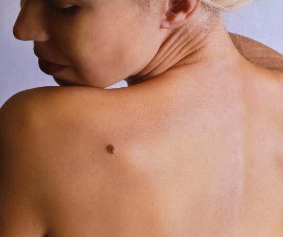 Melanoma: What You Need to Know