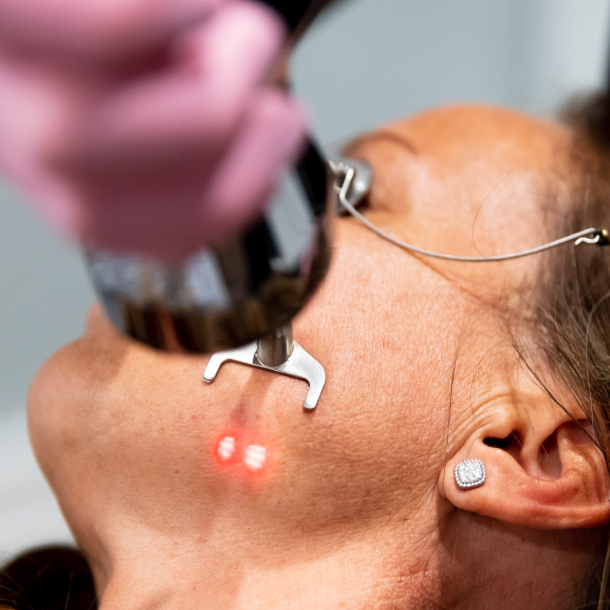 Profractional Laser