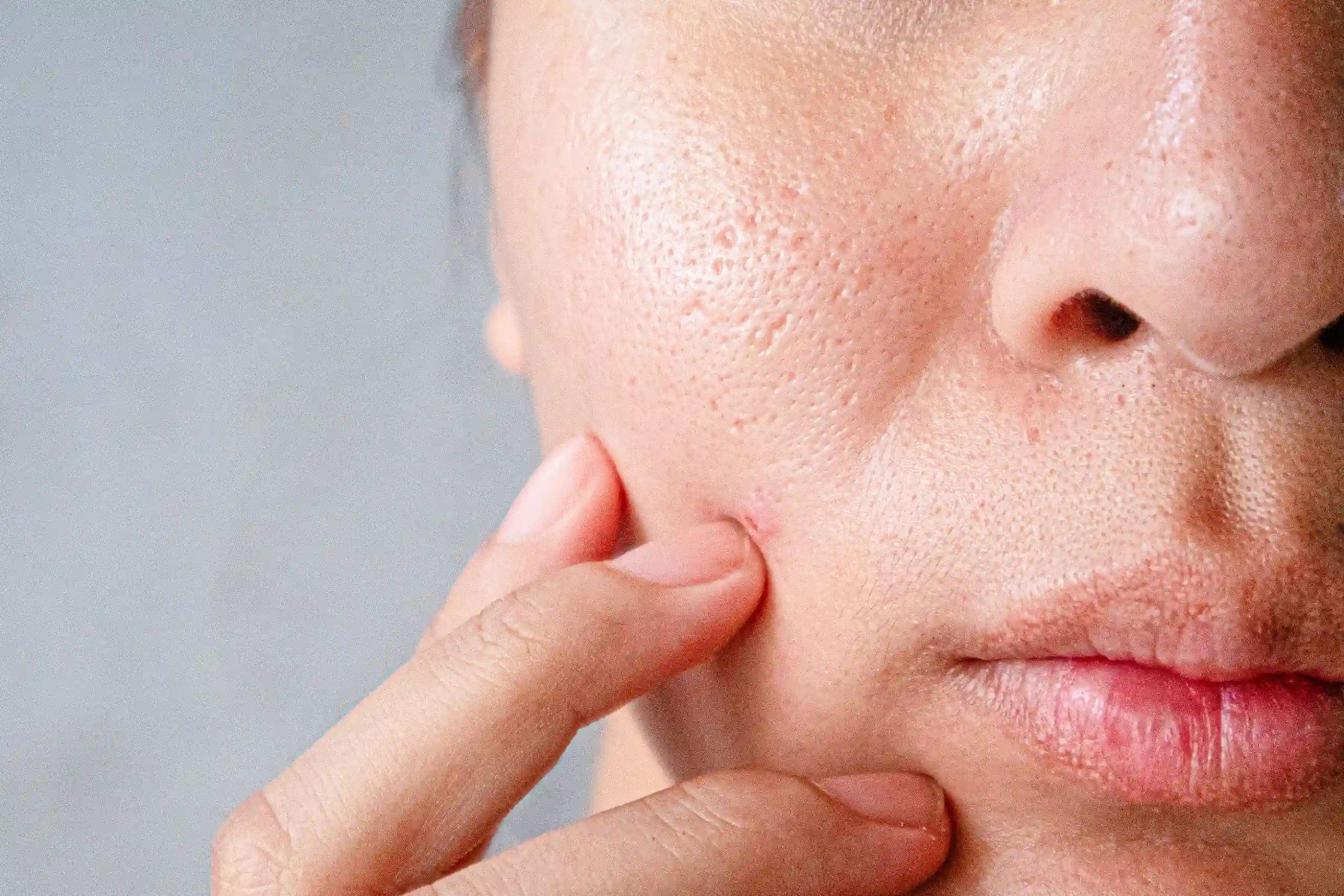 Enlarged Pores Treatment